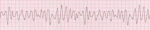 Ventricular Fibrillation