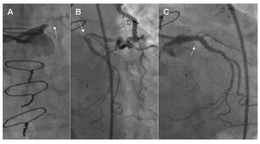 Ventricular Fibrillation