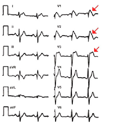 prolungamento dell'intervallo QT o il pattern di Brugada