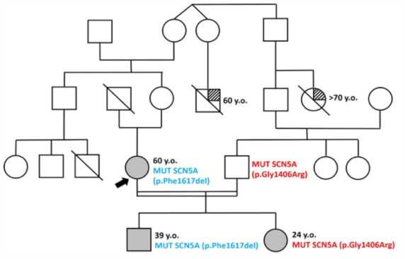 albero genealogico di una famiglia in cui segrega una forma di Brugada