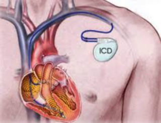 Implantable Cardioverter Defibrillator (ICD) - AF-ABLATION