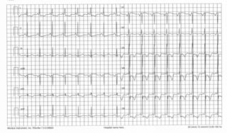 Alterazioni aspecifiche del tracciato ECG (con alti voltaggi del QRS e onde T negative) e aritmie (tachicardia da rientro nodale, fibrillazione e flutter atriale, aritmie ventricolari)