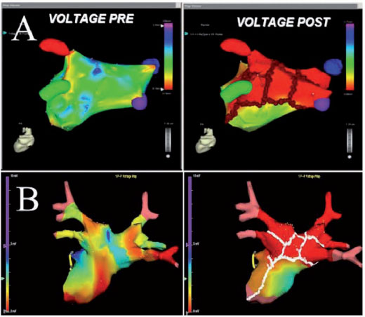 Atrial Fibrillation (AF) Ablation