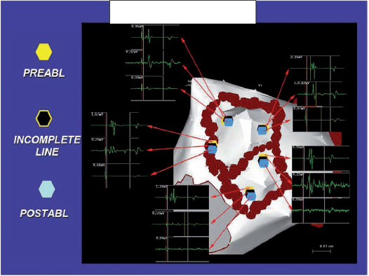 Atrial Fibrillation (AF) Ablation