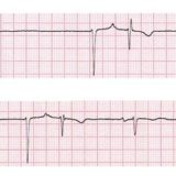 bradiaritmie bradyarrhythmia