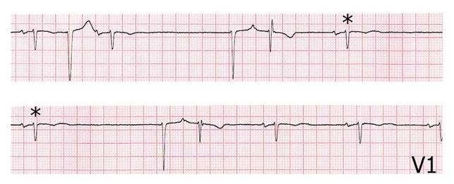 bradiaritmie bradyarrhythmia