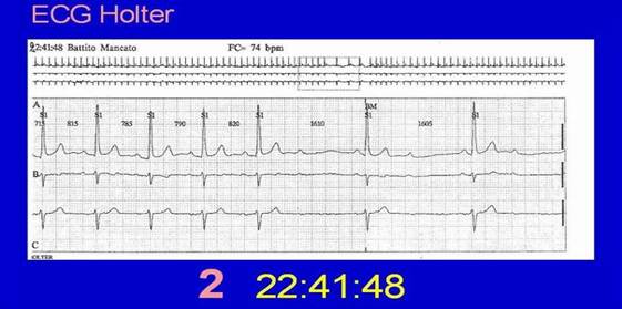 bradiaritmie bradyarrhythmia