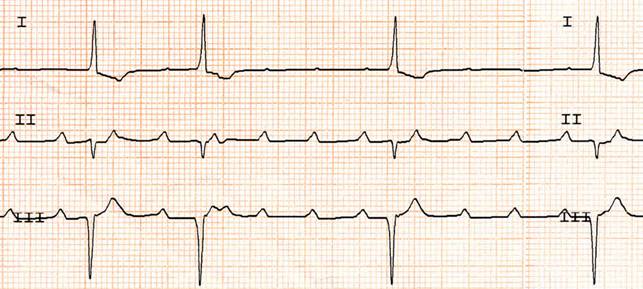 bradiaritmie bradyarrhythmia