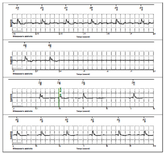 Example of bradyarrhythmia with symptomatic pause> 6 sec for presyncope in patient with ILR