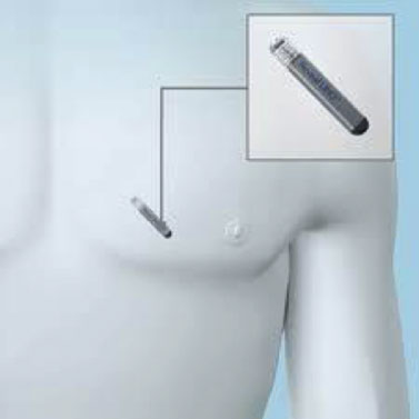 ILR implant site (in precordial subcutaneous area)