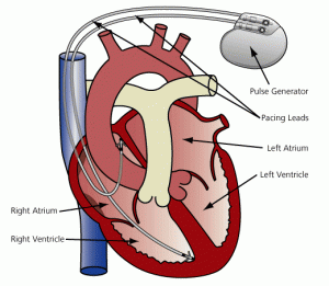 impianto del pacemaker