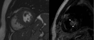 Cardiomiopatia ipertrofica con evidenza di aree di late gadolinium enhancement in corrispondenza delle giunzioni con la parete libera ventricolare destra indicative di sostituzione fibrotica.