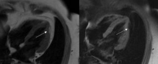 Displasia aritmogena biventricolare associata ad area di infiltrazione adiposa della parete  laterale distale e dell’apice del ventricolo sinistro.