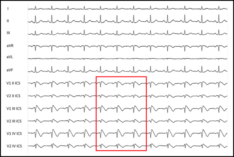 sindrome di brugada Brugada Syndrome (BrS)