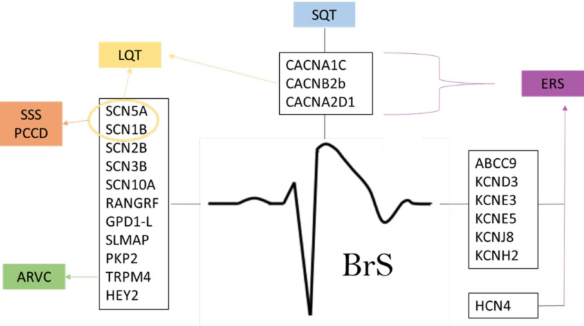 sindrome-di-brugada sindrome di brugada Brugada Syndrome (BrS)