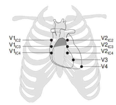 sindrome-di-brugada sindrome di brugada Brugada Syndrome (BrS)