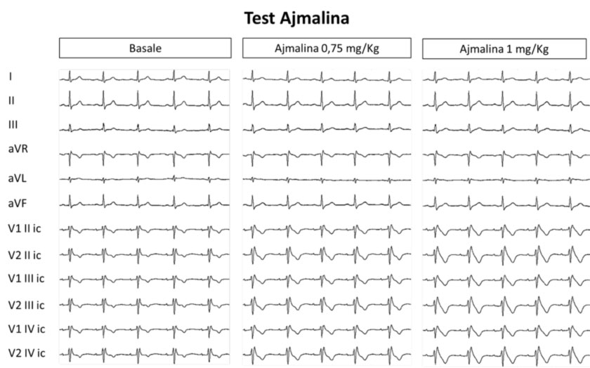 sindrome-di-brugada test con Ajmalina