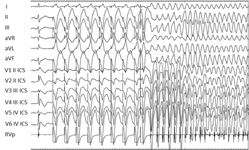 sindrome-di-brugada sindrome di brugada Brugada Syndrome (BrS)