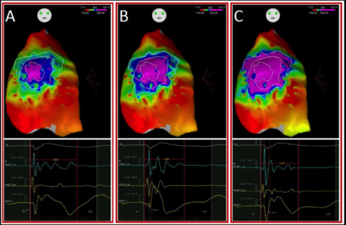 sindrome-di-brugada sindrome di brugada Brugada Syndrome (BrS)