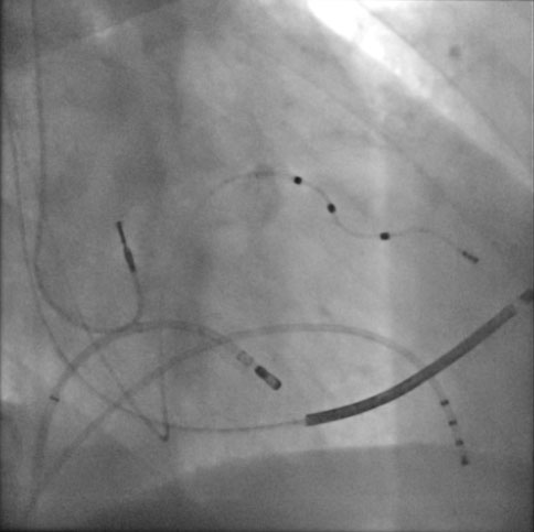 Ablation and Modulation of the Atrio-Ventricular Node