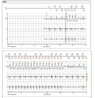 Esempio di tachicardia ventricolare non sostenuta in paziente affetto da sindrome di Brugada portatore di ICD