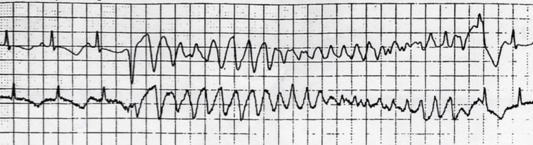 si visualizza sul tracciato ECG come prolungamento dell’intervallo QT e come anomalie morfologiche della ripolarizzazione ventricolare