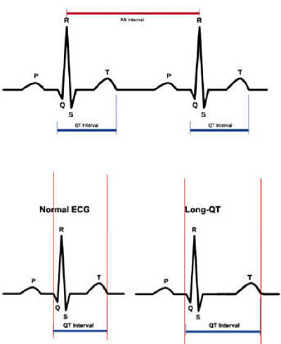 Sindrome del QT lungo Long QT Syndrome