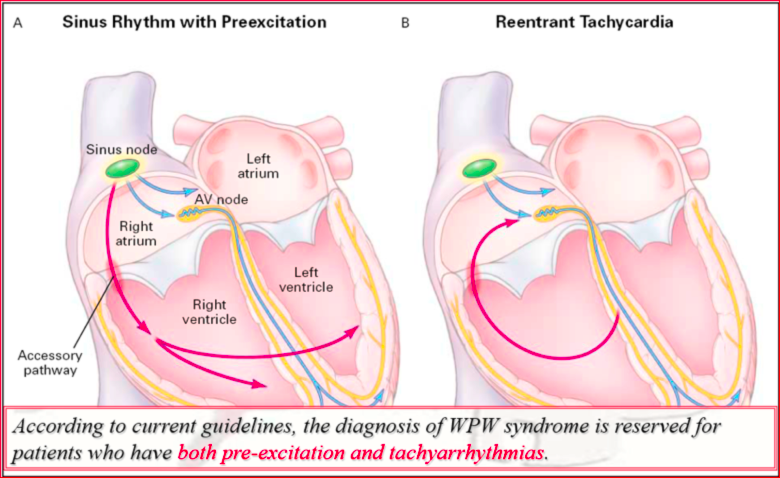 Wolff-Parkinson White Syndrome WPW