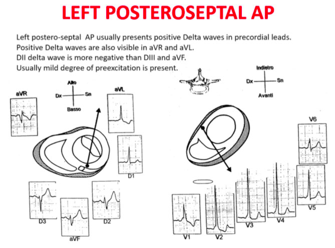 AP postero-settale sinistro