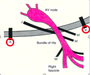 Wolff-Parkinson White Syndrome WPW