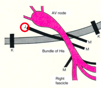 Wolff-Parkinson White Syndrome WPW