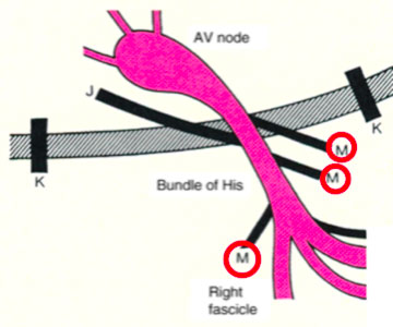 Wolff-Parkinson White Syndrome WPW