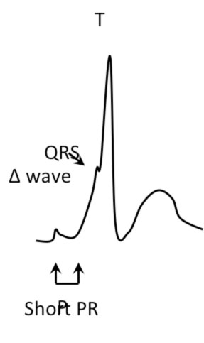 WPW - ECG