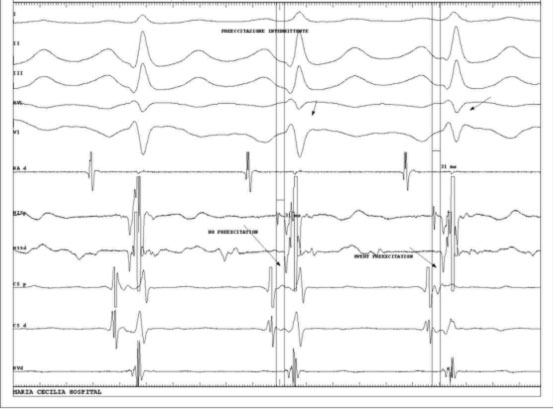 Wolff-Parkinson White Syndrome WPW