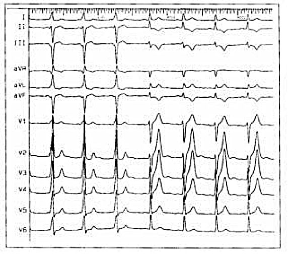In questo ECG primi tre complessi ventricolari sono pre-eccitati, mentre nei battiti seguenti scompare la pre-eccitazione, il QRS si normalizza e il vettore T riproduce esattamente la direzione del vettore QRS durante la pre-eccitazione (fenomeno di memoria elettrica).