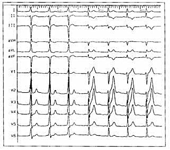 Wolff-Parkinson White Syndrome WPW