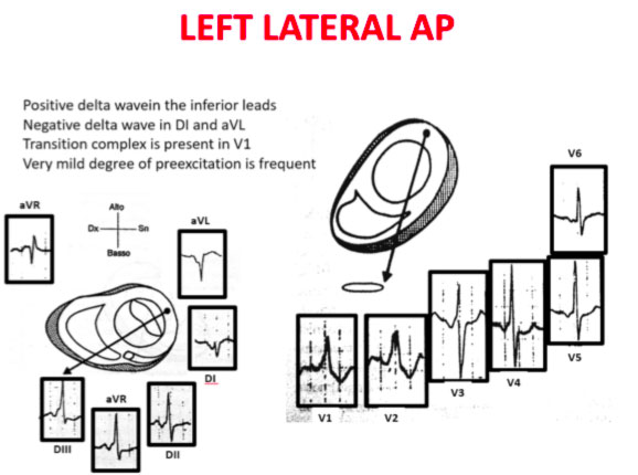 Antidromic Wpw 12 Lead Ekg