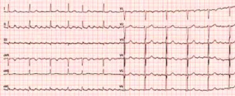 FLA - L’ECG mostra tipico pattern di onde F a denti di sega