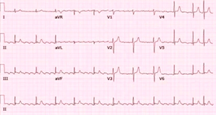 FLA - L’ECG mostra onde F positive (a denti di sega capovolta) nelle derivazioni inferiori (DII, DIII, aVF), bifasiche di basso voltaggio in I e aVL e negative in V1